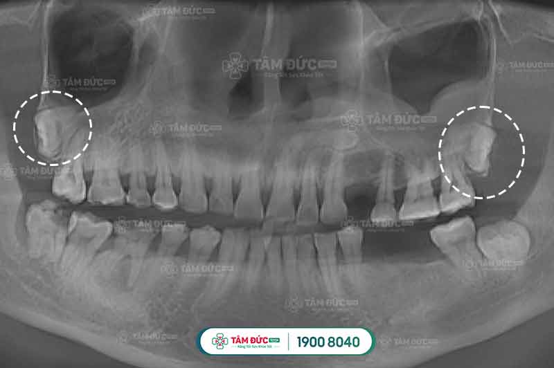 răng khôn đang đau nhổ được không