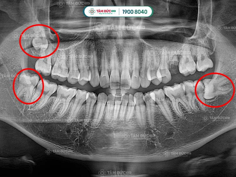 răng khôn mọc lệch 45 độ