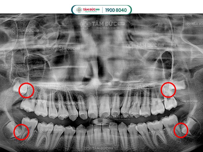 răng khôn mọc lệch 45 độ