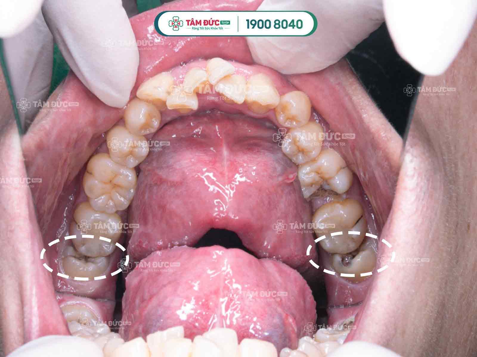 4. Răng khôn mọc lệch có nên nhổ không?