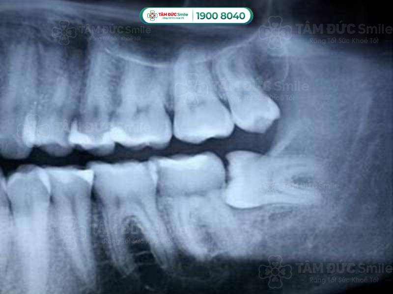 răng khôn mọc ngang có nhổ bỏ được không