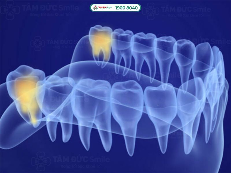 răng khôn mọc thẳng có cần nhổ bỏ không nhổ có đau không