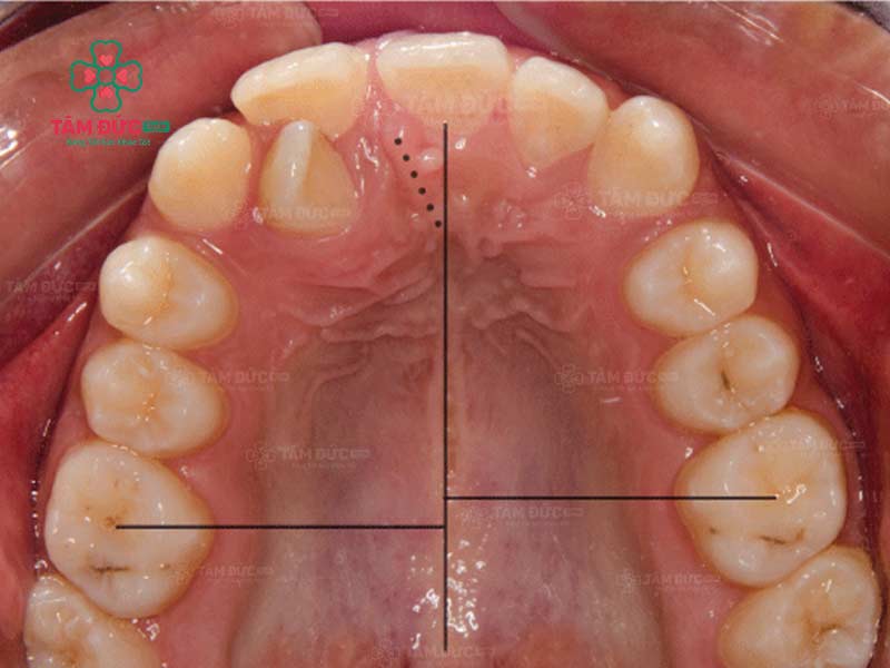 răng lệch nhân trung