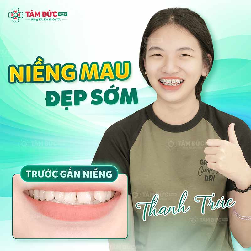 khách hàng niềng răng tại nha khoa Tâm Đức Smile