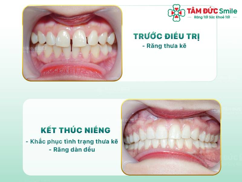 trước và sau khi niềng răng tại Tâm Đức Smile