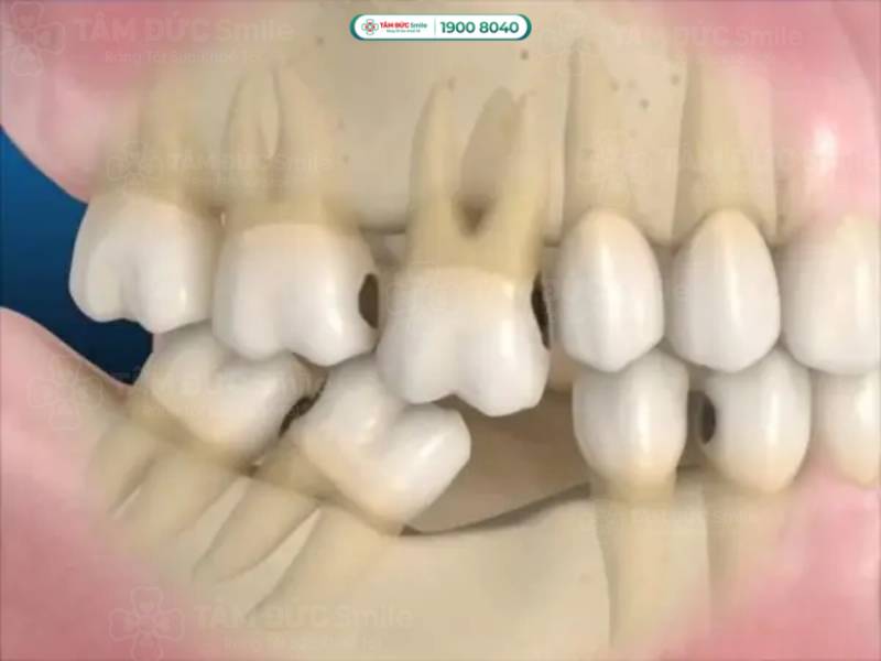 răng lung lay không đau nhưng khiến răng bị mọc lệch