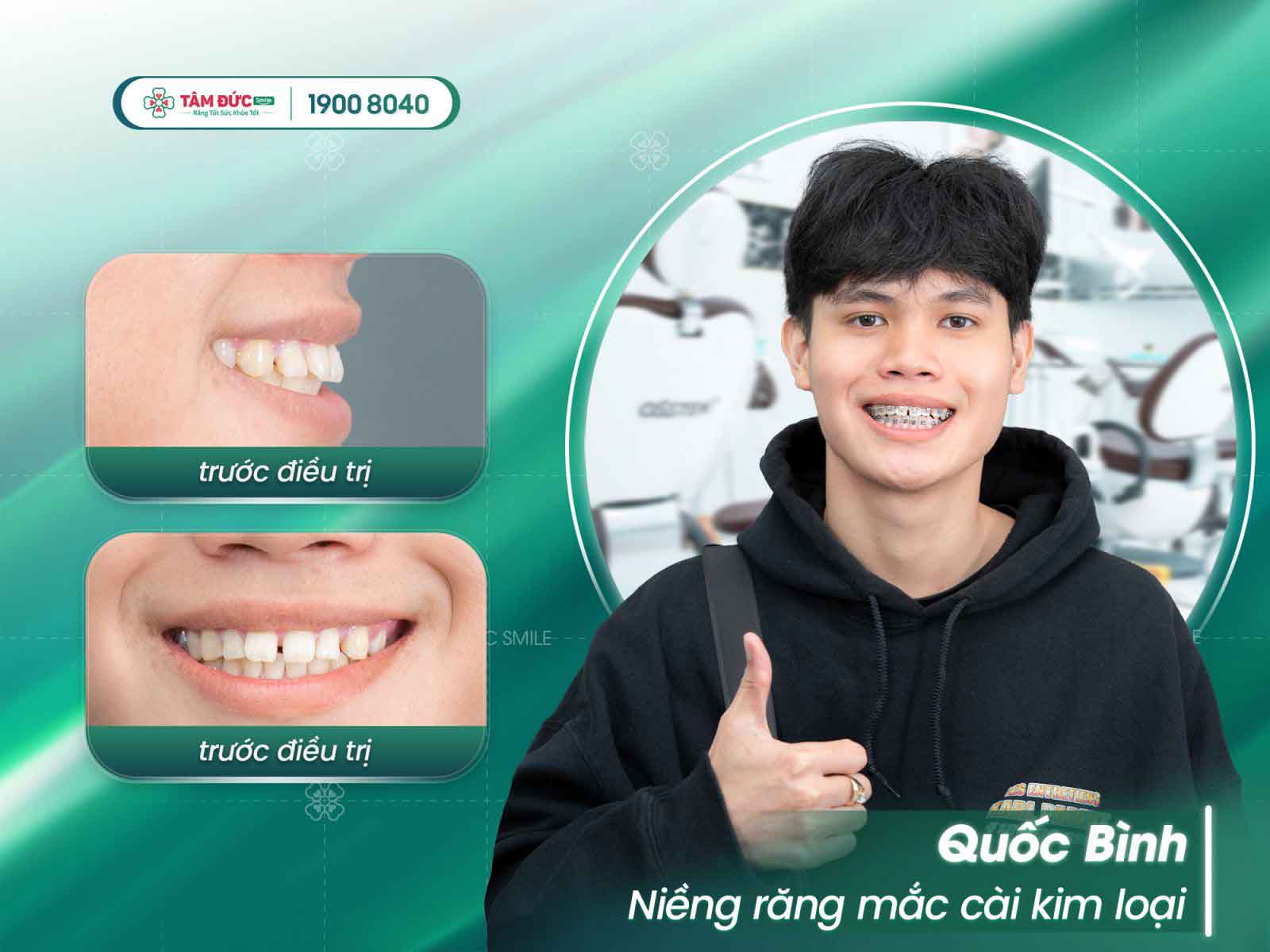 niềng răng mắc cài khắc phục tình trạng răng mọc tùm lum