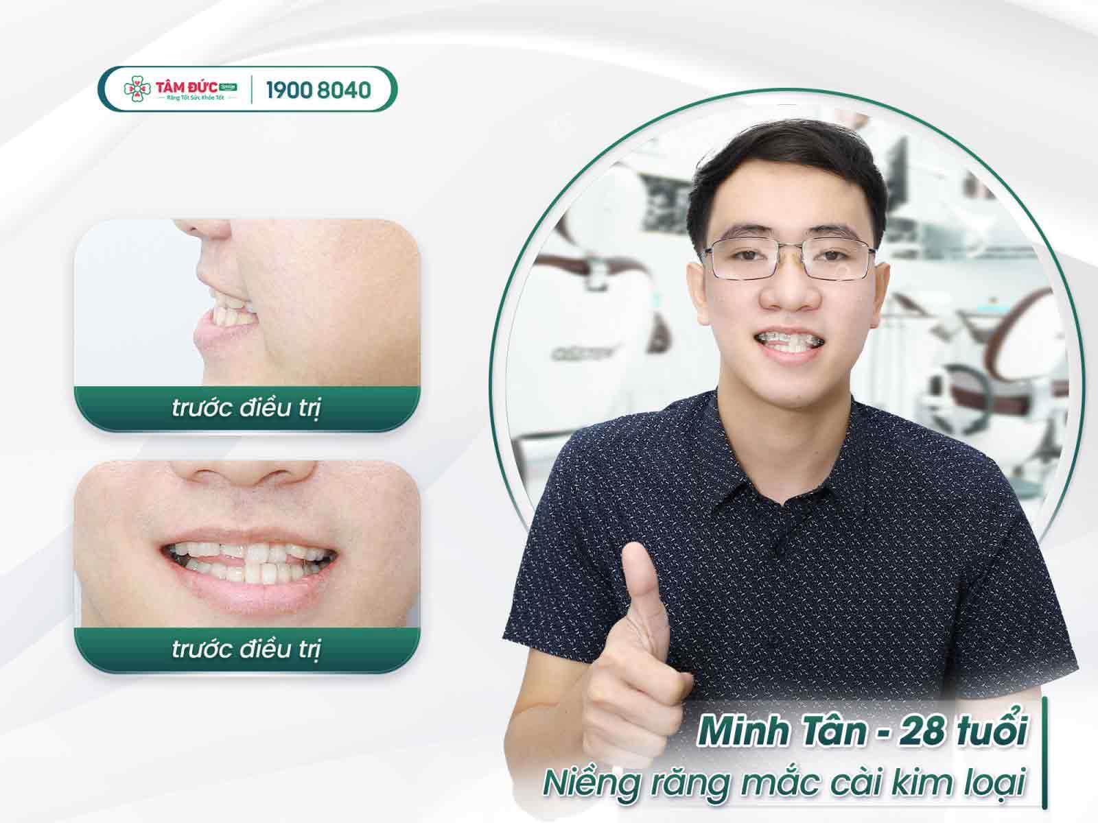 niềng răng mắc cài khắc phục tình trạng răng mọc tùm lum