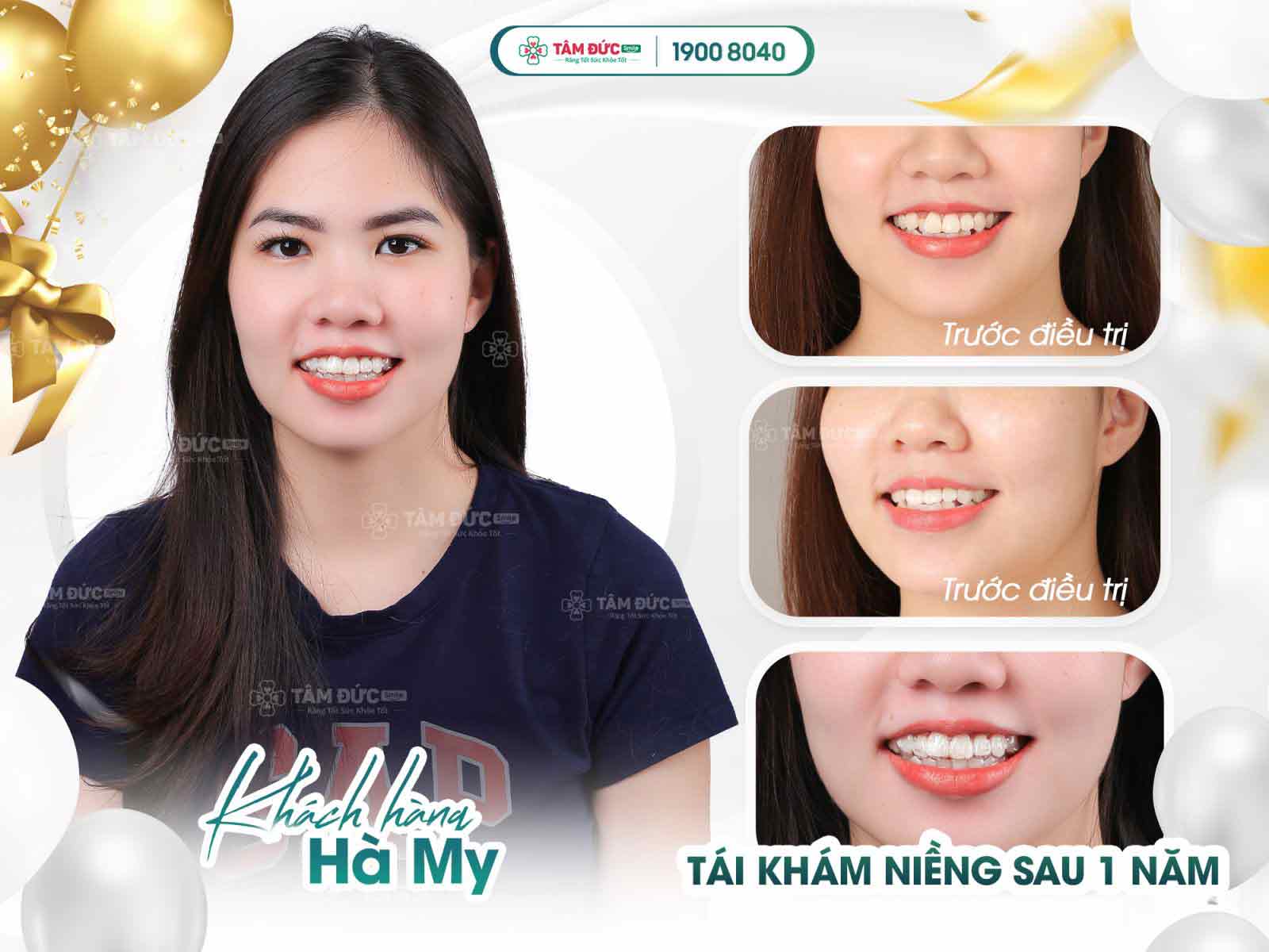 Những cải thiện sau khi niềng răng tại nha khoa Tâm Đức Smile