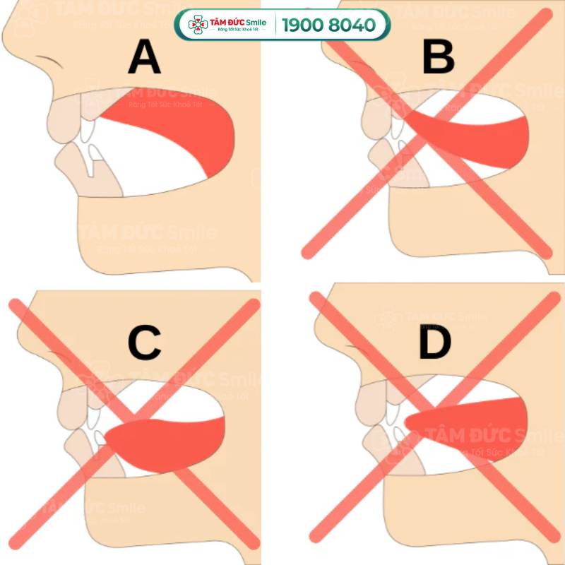 răng móm cười sao cho đẹp