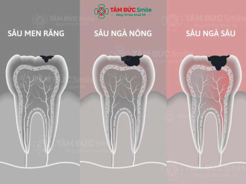 Răng sâu độ 3 là như thế nào