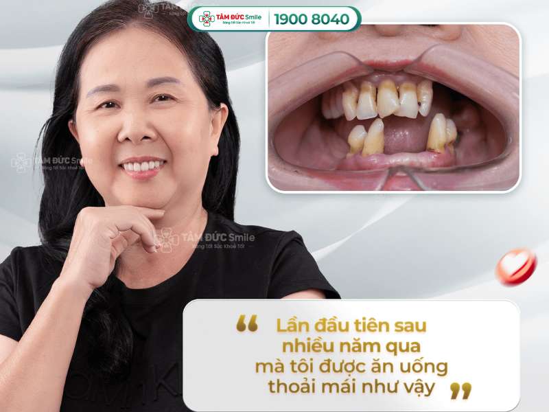 Răng sâu độ 4 là như thế nào