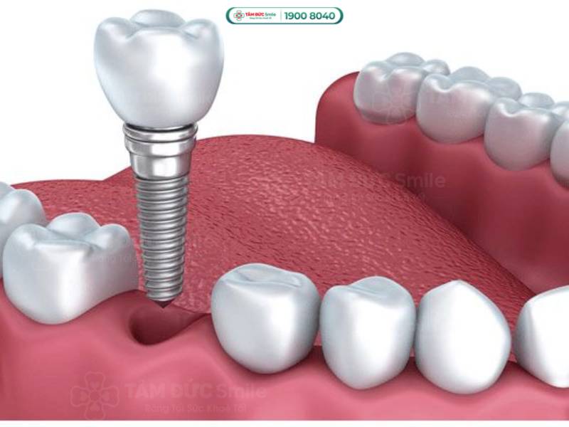 trồng răng implant