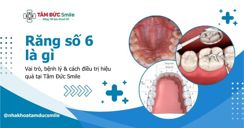 Răng số 6 là gì? Vai trò, bệnh lý & cách điều trị hiệu quả tại Tâm Đức Smile