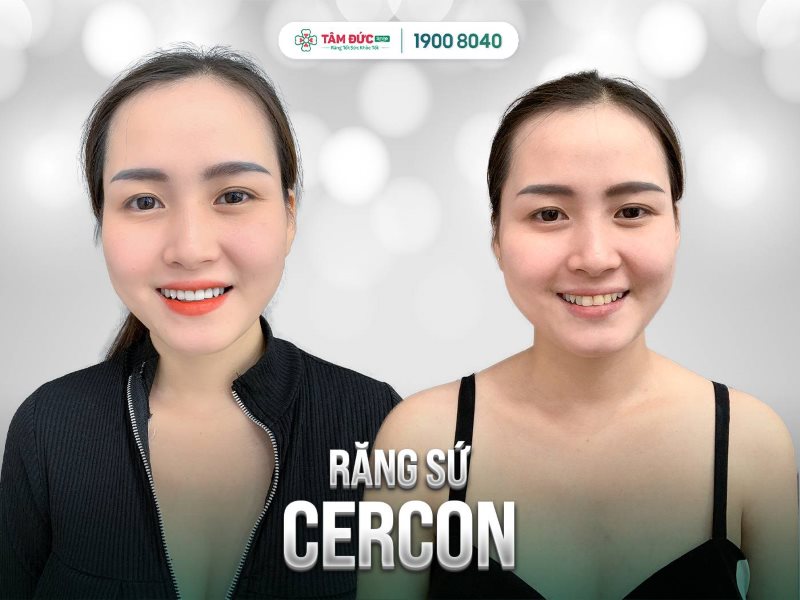 răng sứ cao cấp cercon