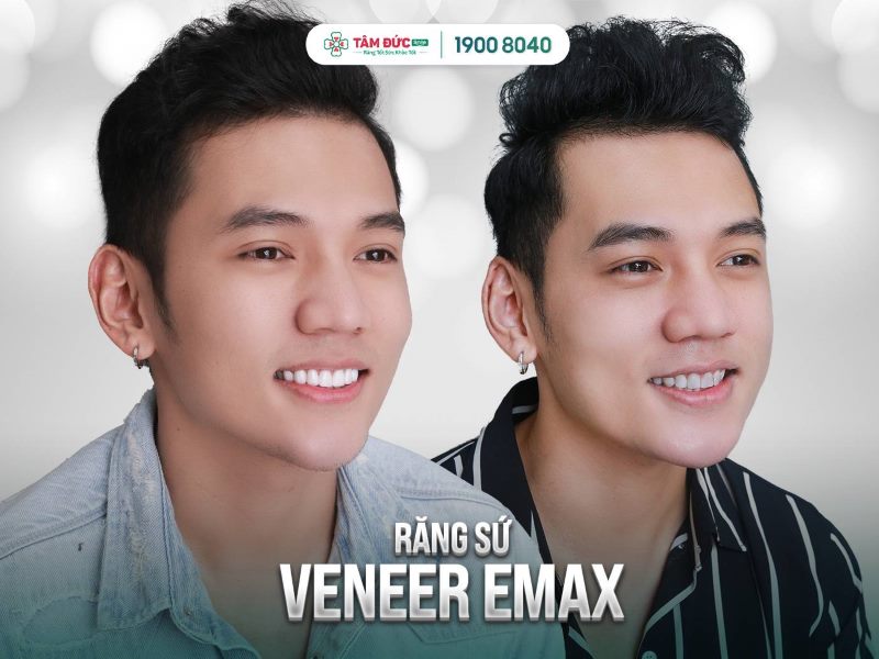 dán sứ cao cấp veneer emax