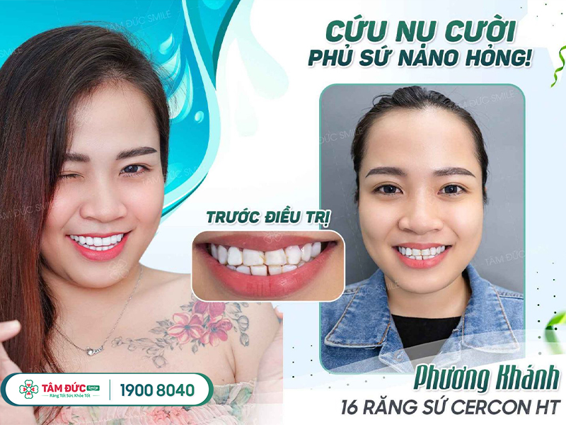 răng sứ mỹ