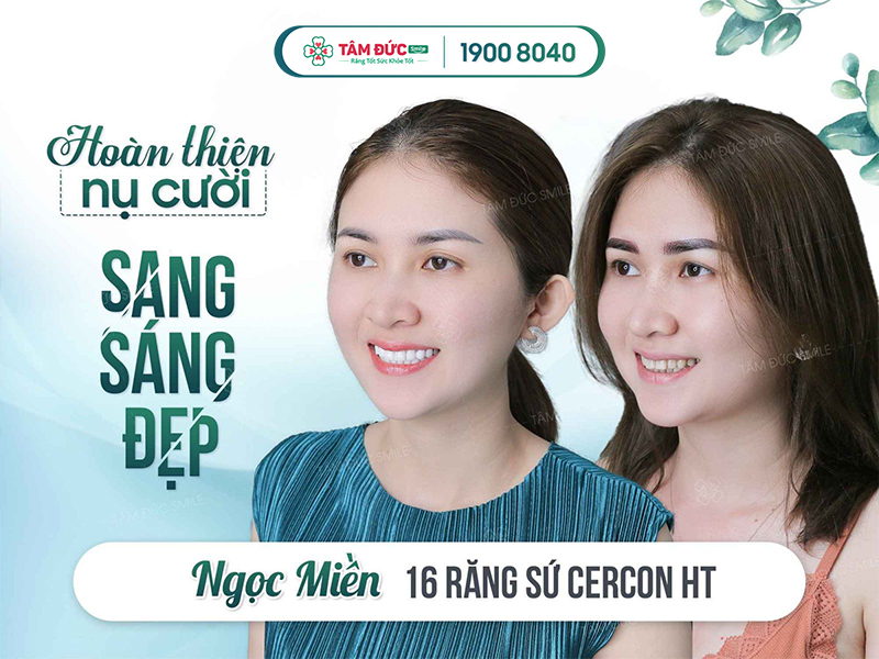 răng sứ cercon ht mỹ