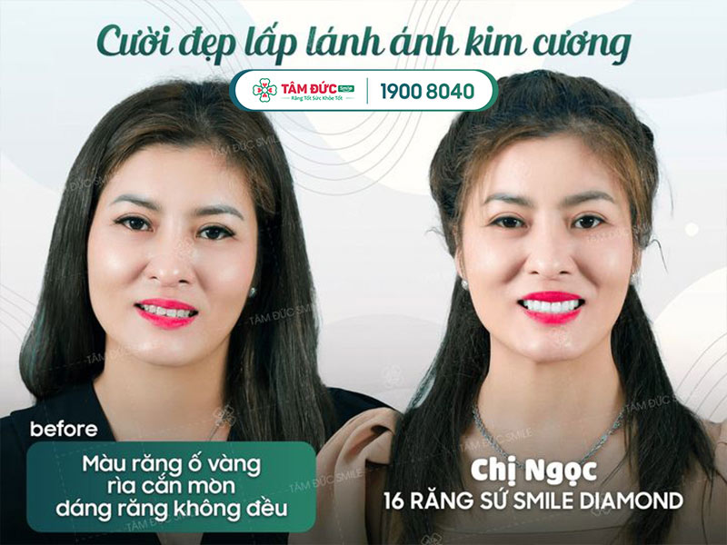 răng sứ smile diamond