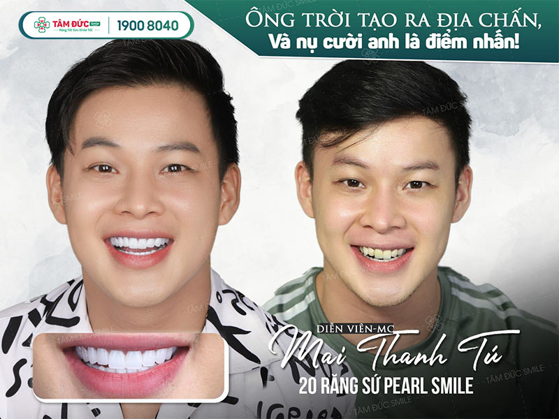 diễn viên Mai Thanh Tú sau khi làm răng sứ tại nha khoa Tâm Đức Smile