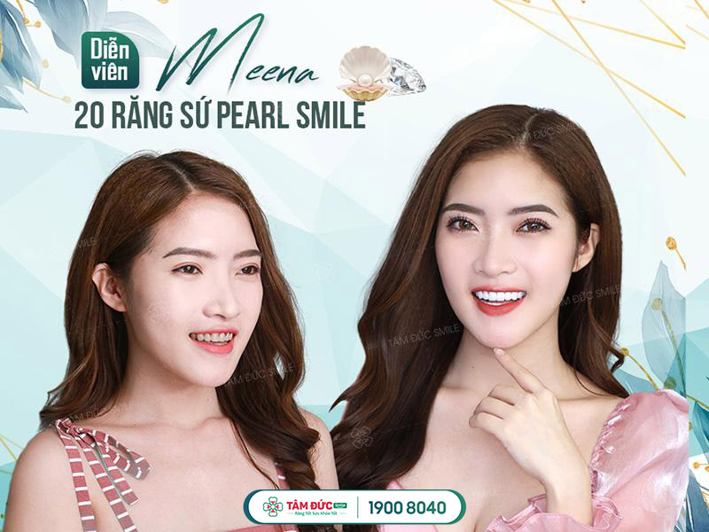 diễn viên Meena sau khi làm răng sứ pearl smile tại nha khoa Tâm Đức Smile