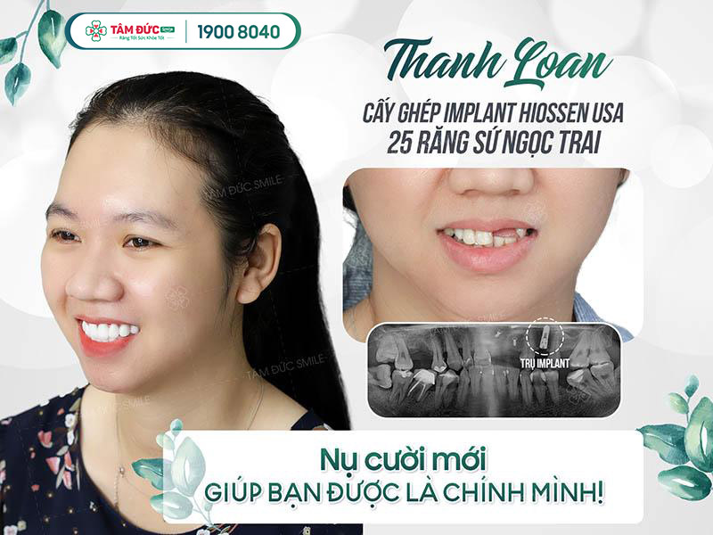 Chị Thanh Loan sau khi bọc răng sứ tại nha khoa Tâm Đức Smile