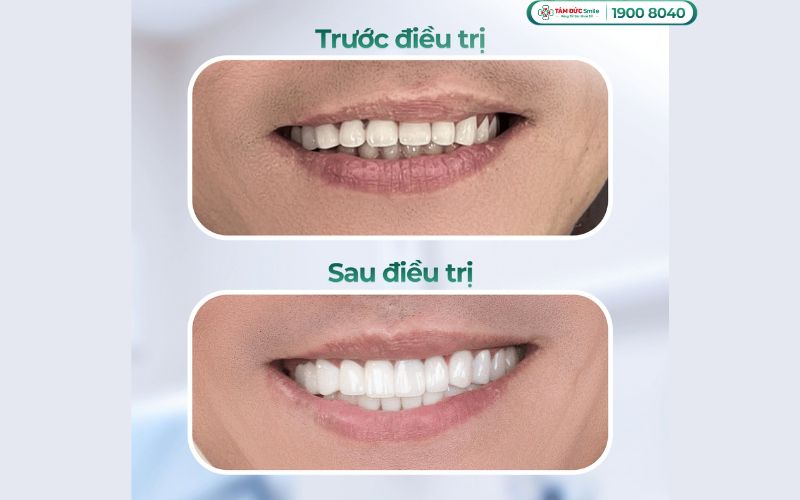 rang-su-zirconia-4