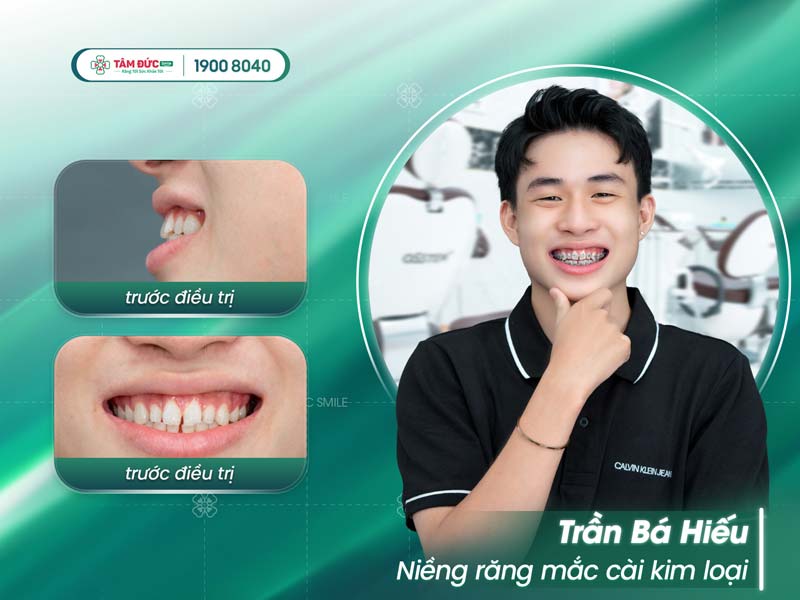 khách sau khi gắn mắc cài điều trị răng thưa hàm dưới tại Tâm Đức Smile