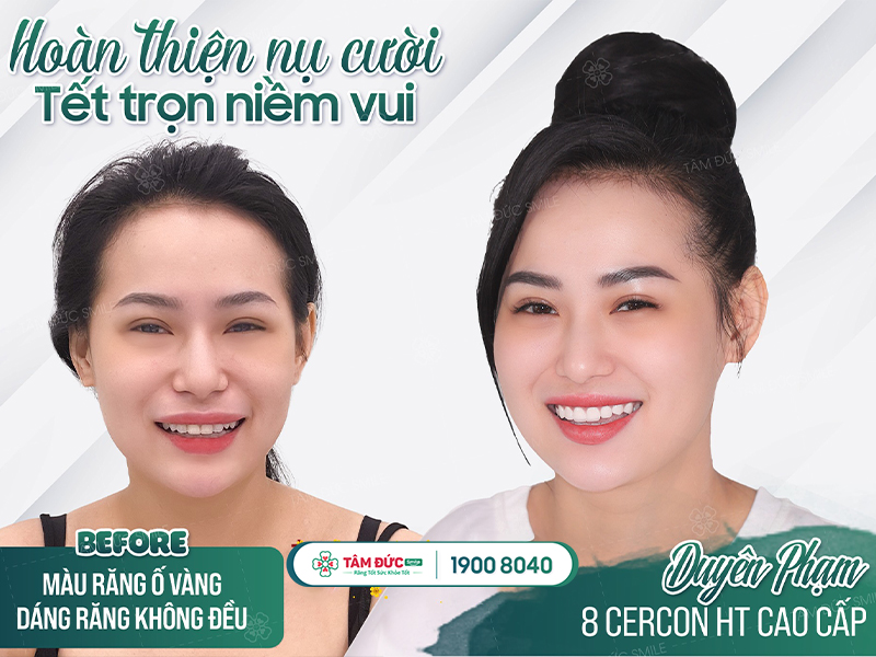 phục hình răng toàn sứ tại nha khoa Tâm Đức Smile