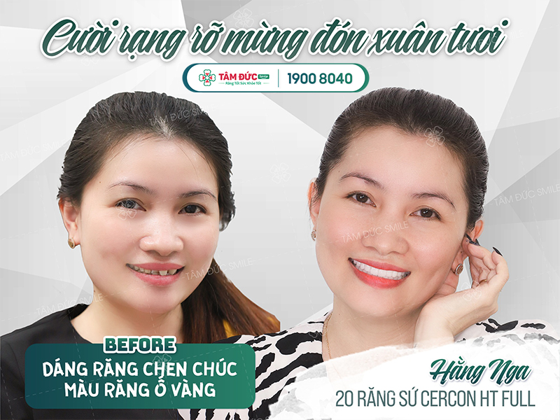 phục hình răng sứ bằng răng cercon ht