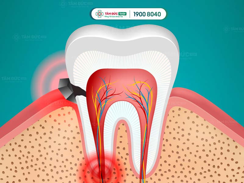 răng trám rồi vẫn đau do chưa làm sạch nhiễm trùng