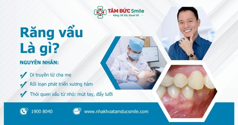 Răng vẩu là gì? Nguyên nhân, ảnh hưởng và cách điều trị hiệu quả, an toàn