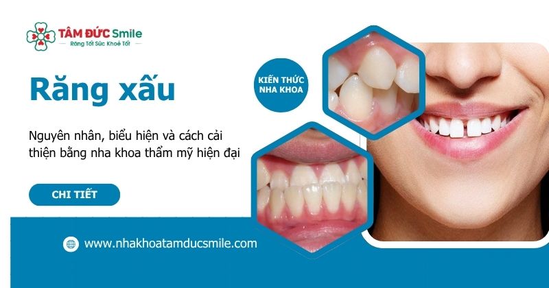 Răng xấu: Nguyên nhân, biểu hiện và cách cải thiện bằng nha khoa thẩm mỹ hiện đại