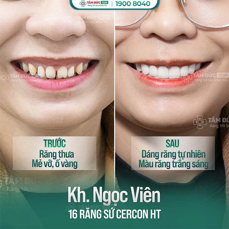 so sánh răng sứ kim loại với răng toàn sứ