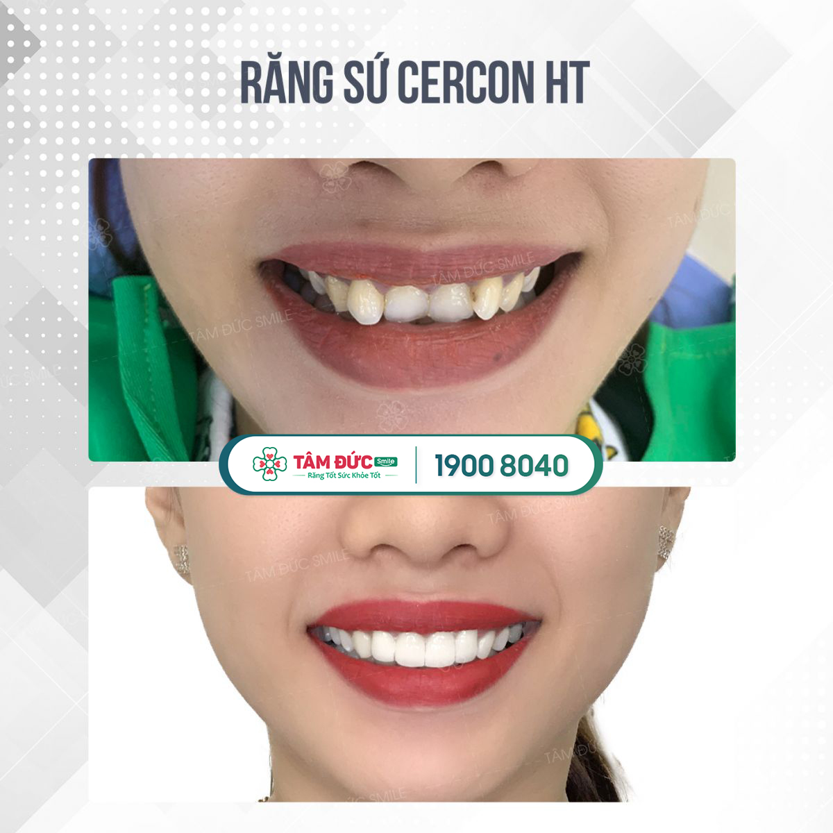 so sánh răng sứ zircomax và cercon ht