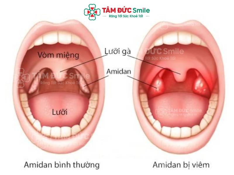 súc miệng nước muối ngày mấy lần là tốt nhất