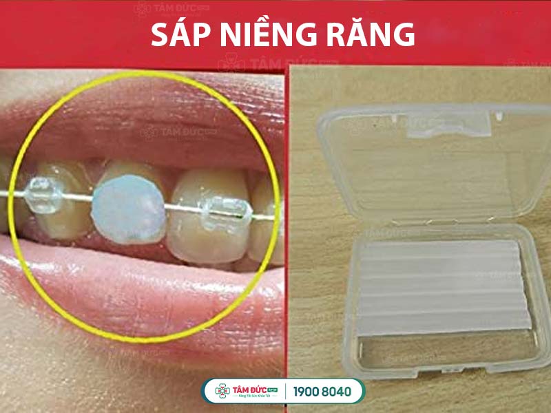 sáp niềng răng