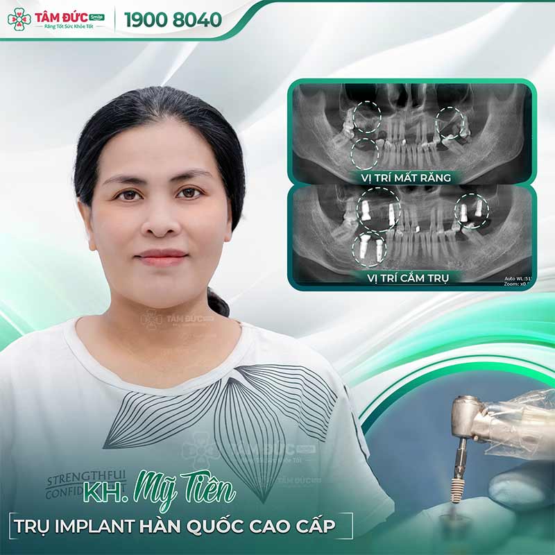 trồng răng Implant giúp ngăn ngừa viêm nướu chân răng hiệu quả