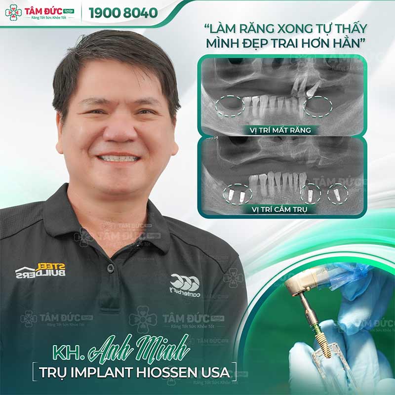 trồng răng Implant giúp ngăn ngừa viêm nướu chân răng hiệu quả