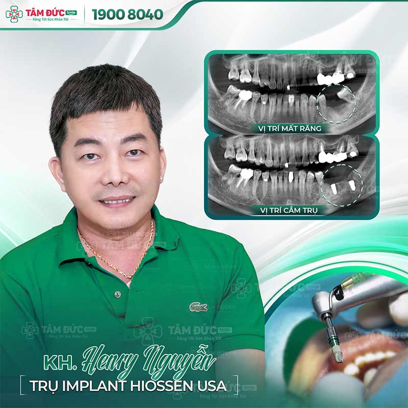 trồng răng Implant giúp ngăn ngừa viêm nướu chân răng hiệu quả