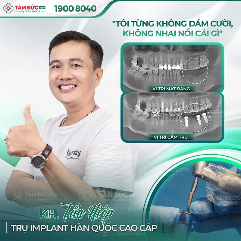 trồng răng Implant giúp ngăn ngừa viêm nướu chân răng hiệu quả