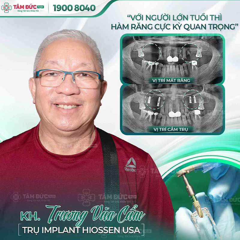 trồng răng Implant giúp ngăn ngừa viêm nướu chân răng hiệu quả