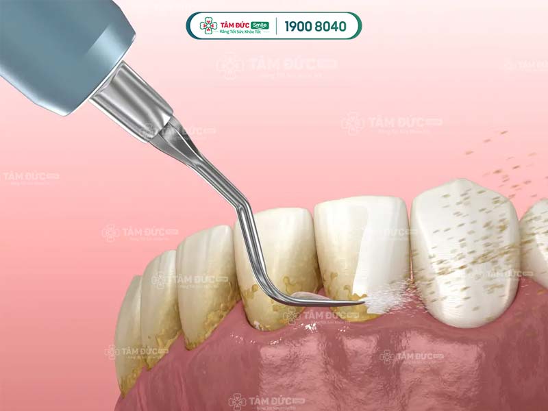 cạo vôi răng giúp khắc phục kẽ răng bị ố vàng nhanh chóng và hiệu quả