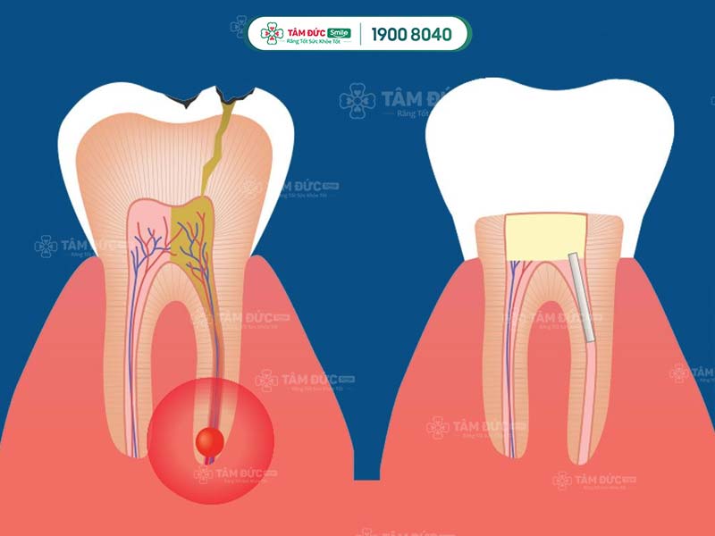 tại sao lấy tuỷ răng lần 1 vẫn còn đau