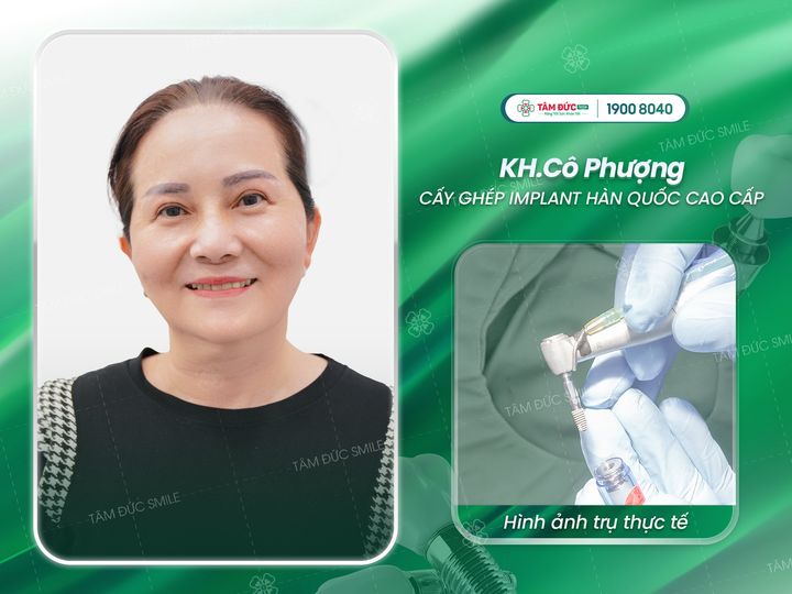 tại sao phải trồng Implant sau khi mất răng