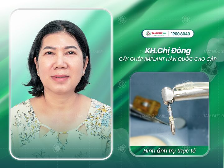 tại sao nên trồng Implant sau khi mất răng