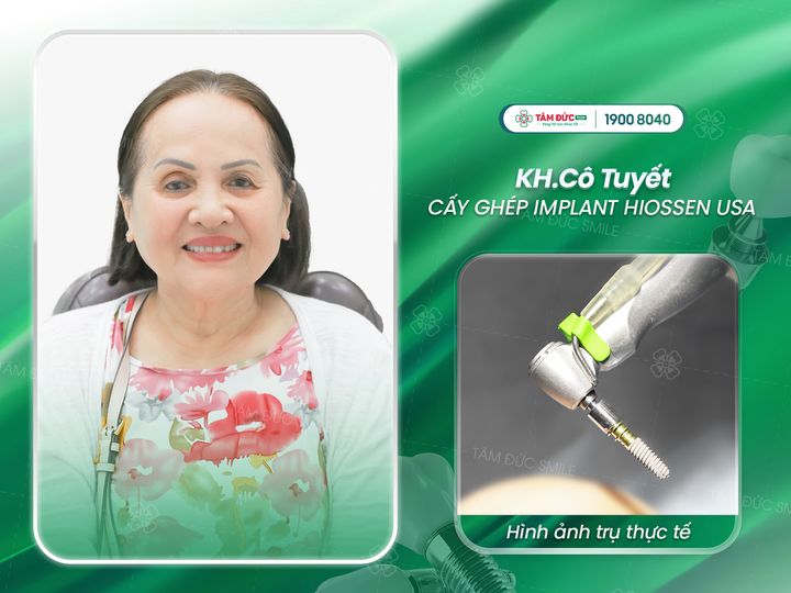 cô Tuyết sau khi trồng răng Implant tại nha khoa Tâm Đức Smile