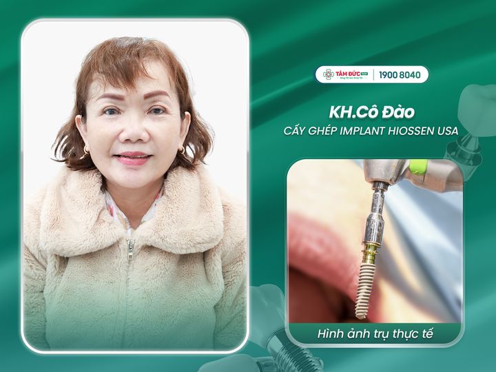 tại sao phải trồng Implant khi mất răng