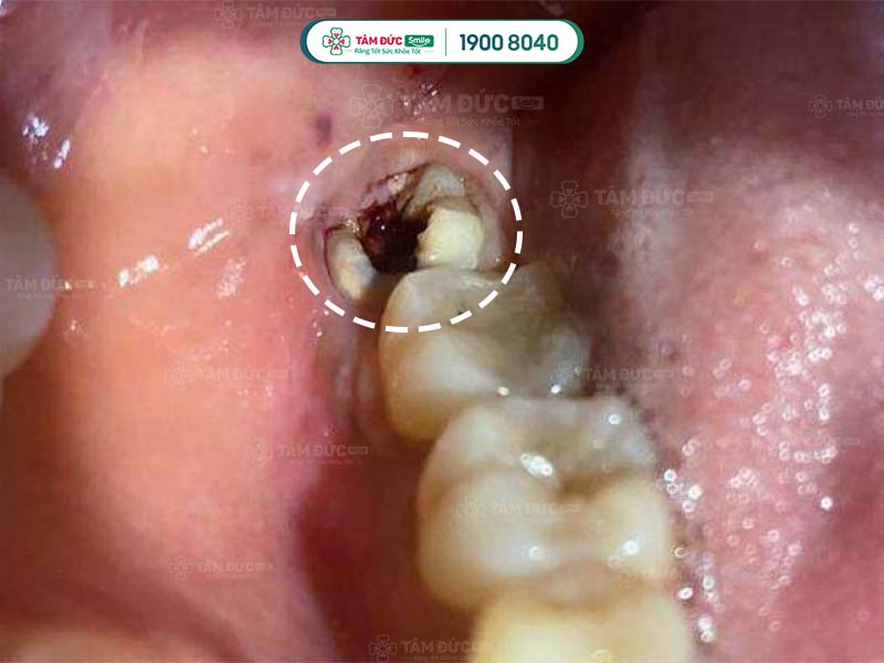 răng khôn bị sâu làm đau họng sau khi nhổ răng khôn