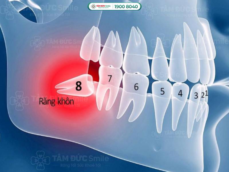 tại sao nhổ răng khôn lại nguy hiểm